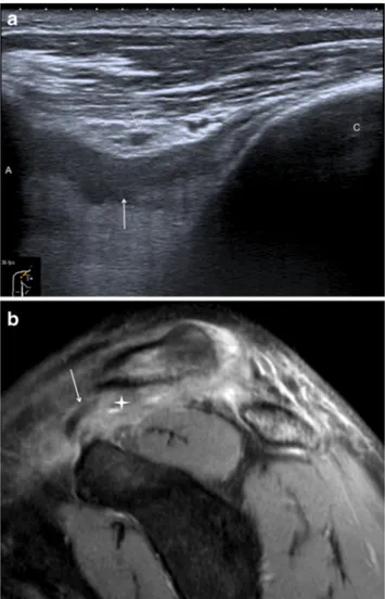 Fig. 3 Discrepancy between ultrasound and MRI. a) Ultrasound shows grade 2: the trapezoid ligament in the longitudinal view (arrow) is thickened, distended, but continuous