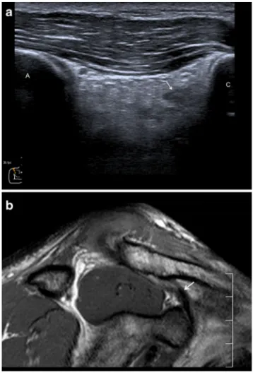 Fig. 5 Discrepancy between radiography, ultrasound and MRI findings: a grade 3 injury was found on ultrasound and MRI, but this was classified as grade 2 on radiographs