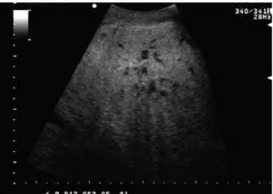 Figure  11  :  Image  échographique  normale  du  parenchyme  mammaire  en  partie  moyenne  du  pis  (Babkine 2008a) 