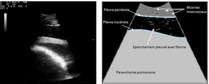 Figure  29  :  Image  échographique  d'un  épanchement  pleural.  Image  pathologie  des  ruminants  ENVT