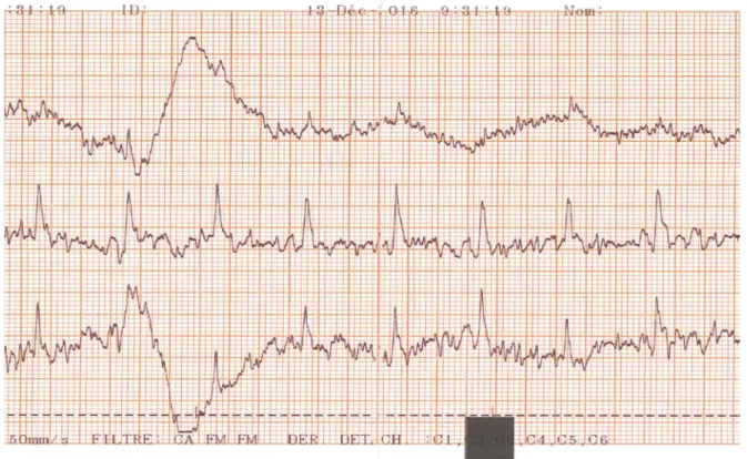 Figure 6 : Exemple de tracé ECG ininterprétable chez un chat.  