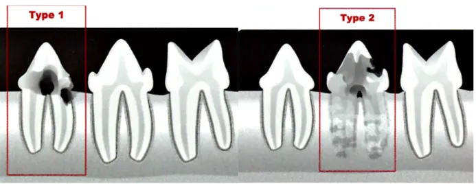 Figure  9 :  Différences  radiographiques  permettant  de  définir  le  type  d’une  lésion  de  résorption odontoclastique (Crédit figure : Hennet, Boutoille 2013)