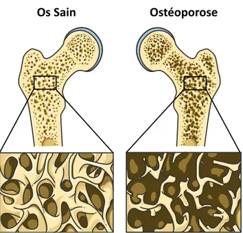 Figure 6. Différence entre un os sain et un os atteint d'ostéoporose (figure adaptée de Servier Medical Art) 