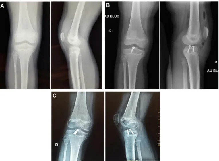 Fig. 1. A. AP and lateral radiographs of a type II tibial intracondylar eminence fracture in an 8-year-old female after a skiing accident