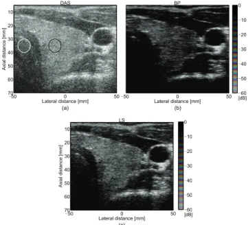 Fig. 11 presents the BF results of healthy thyroid data. The thyroid (echoic region) is situated between the trachea and the carotid artery (laterally, between −20 and 30 mm approximately)
