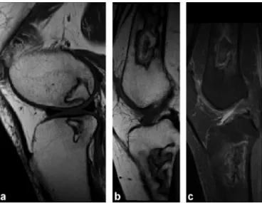 Figure 10. Necrosis of the medial femoral condyle, T1-weighted image (a) and PD fat-suppressed image (b) in the coronal plane