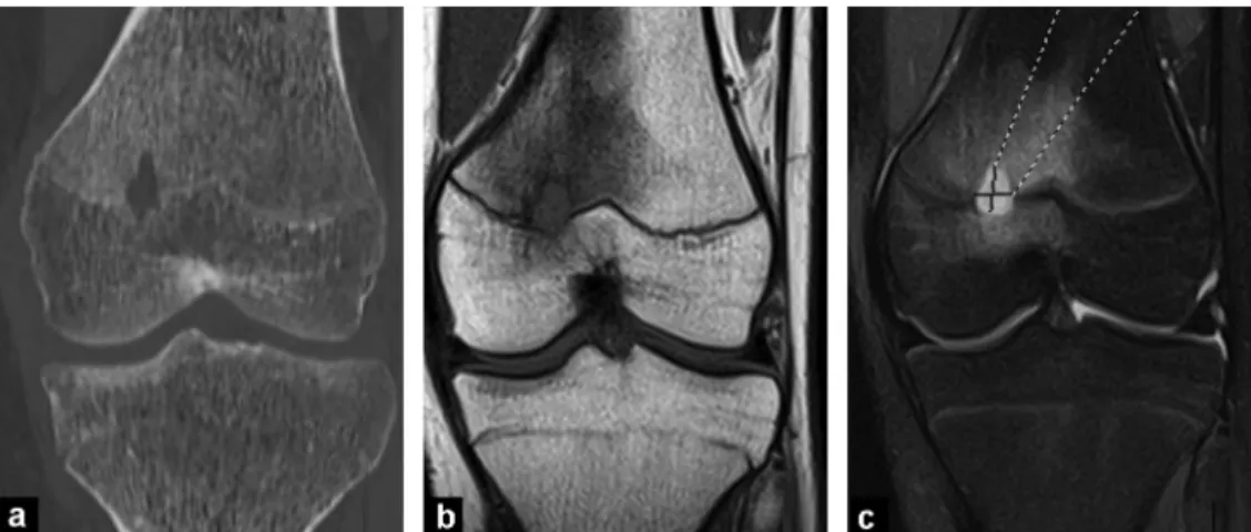 Figure 13. Brodie abscess in the distal femoral metaphysis: a: CT image in the coronal plane shows central osteolysis delimited by a sharp rim; b, c: MR images in the coronal plane show a metaphyseal collection of low signal intensity on T1-weighted images
