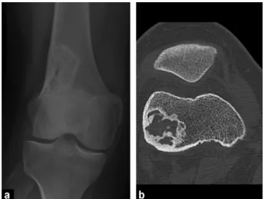 Figure 19. Osteoid osteoma of the tibia: a: CT scan shows a lacuna of the cortex, or ‘‘nidus’’ (arrow); b: the nidus is enhanced (arrow) on fat-saturated T1-weighted images following gadolinium chelate injection.