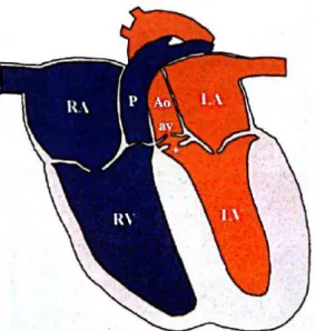 Figure 2 : Représentation schématique d’une sténose pulmonaire 