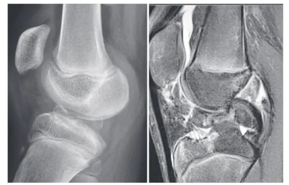 Fig. 3   Patient  no.  9:  45  months  after  the  injury,  the  lateral  radio- radio-graphs  view  in  extension  before  suture  fixation  surgery  reveals  2  separated ossifications (left)