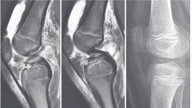 Fig. 4   Intermeniscal  ligament  entrapment  seen  on  MRI  could  explain  failure  of  orthopaedic  treatment  (patient  no