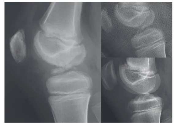 Fig. 5   Suture refixation procedure mainly involves the anterior part of the avulsed fragment (left and up)