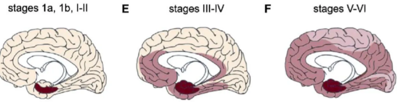 Figure 3 : Propagation des dégénérescences neurofibrillaires 