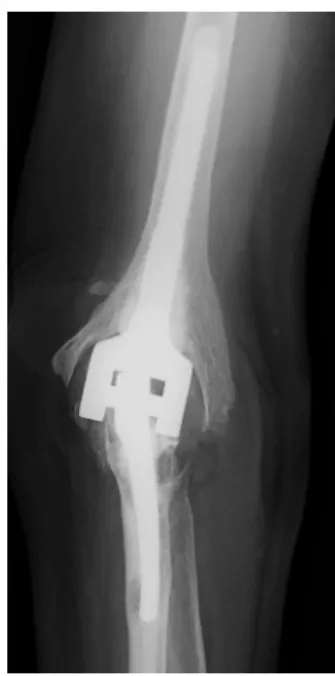 Fig. 1 Polyethylene bushing wear with lucent lines around polymethyl- polymethyl-methacrylate ulnar component 11 years after the initial procedure for post-traumatic arthritis