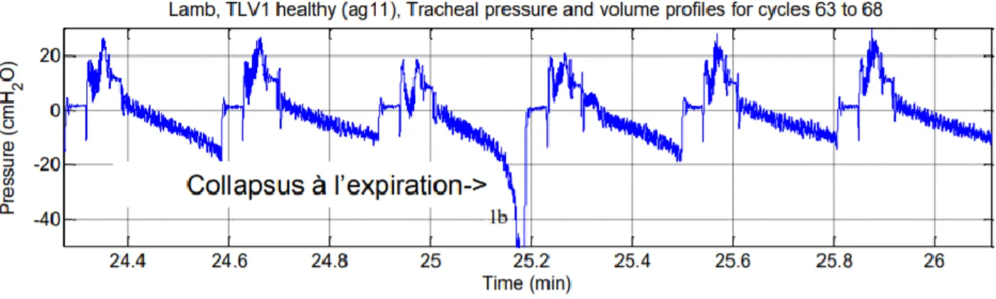 Figure 2.7 : Signal de pression relevé au niveau du « Y » au cours d’une VLT [2] 