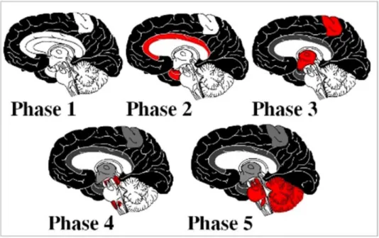 Figure 3 : Progression de la pathologie amyloïde  selon les travaux de Thal. Selon Thal,  la pathologie amyloïde  progresse du néocortex (noir, phase 1), vers les zones allocorticales 