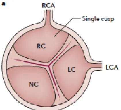 Figure 2. Structure de la valve aortique tricuspide. RC, feuillet coronarien droit (right coronary cusp);  LC, feuillet coronarien gauche (left coronary cusp); NC, feuillet non-coronarien (non-coronary cusp);  LCA,  artère  coronaire  gauche  (left  corona