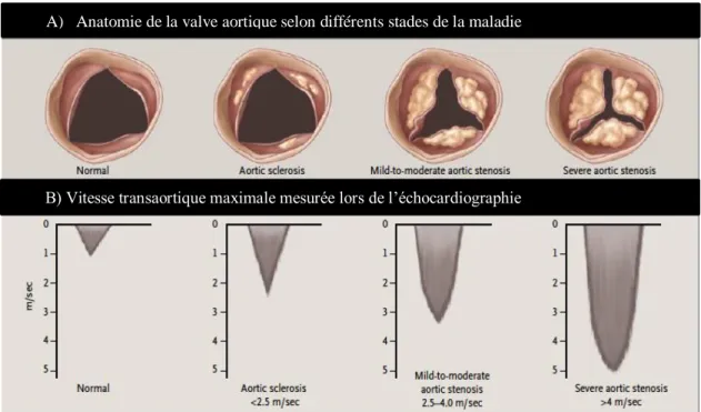 Figure 6. Vitesse transaortique maximale correspondant à l’anatomie de la valve aortique normale et  sténosée à différents grades de la maladie