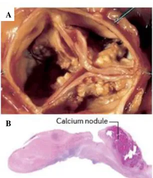Figure 11. Représentation du remodelage fibrocalcique retrouvé dans la SA. (A) Photographie d’une  valve  aortique  sténosée  présentant  un  remodelage  fibrocalcique  important