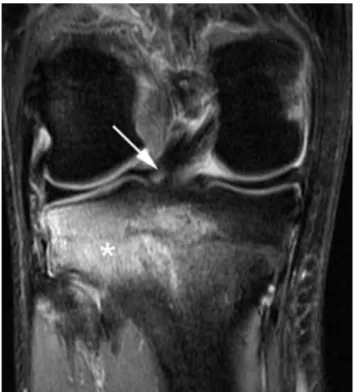 Figure 17. Nodular mass interpositioned between the lateral femoral condyle and the tibia, reﬂecting incarceration of the  rup-tured ACL anterior to the intercondylar notch.