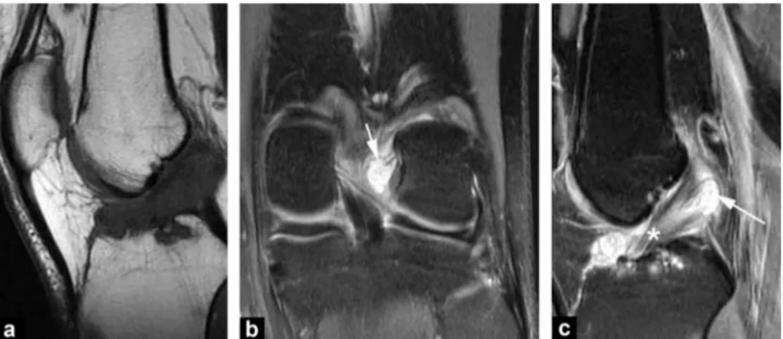 Figure 21. Cyst of the tent of the cruciate ligaments. MRI: T1-weighted sagittal (a), frontal (b) and sagittal (c) proton density views with fat saturation