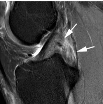 Figure 24. Normal ﬁndings after ligamenoplasty. On fat- fat-suppressed Rhô weighted view, the plasty is homogeneous and hypointense.