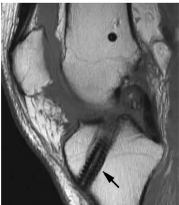 Figure 25. Rupture of a ligamentoplasty. T1-weighted sagittal MRI view: complete disappearance of the plasty ﬁbers (arrow)  indi-cating that it has ruptured