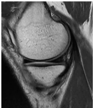 Figure 1. Normal MRI appearance of the medial meniscus. Pro- Pro-ton density-weighted sagittal section: the anterior and posterior meniscal horns appear as a homogeneous, hypointense triangle