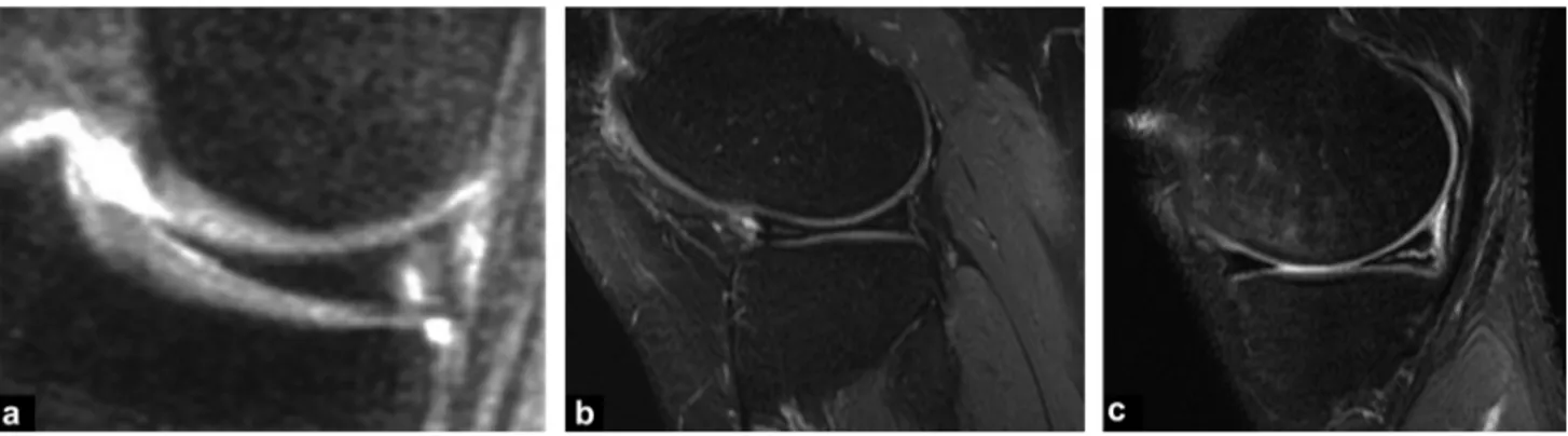 Figure 3. Stoller grades. a: grade 1: one or more intermediary nodular hyperintense sites respecting the joint surfaces of the meniscus; b: grade 2: linear intermediary hyperintensity respecting the joint surfaces of the meniscus; c: grade 3: linear interm