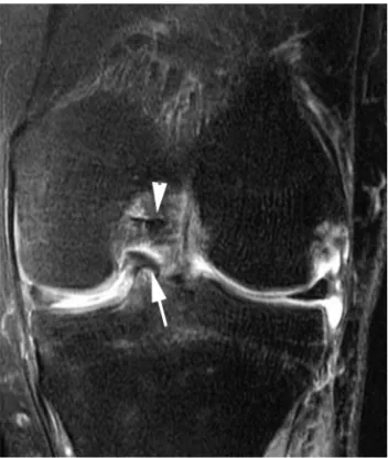 Figure 9. Meniscal contusion. Frontal proton density-weighted view after fat suppression