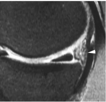 Figure 10. Detachment of the posterior horn of the meniscus. Sagittal proton density view