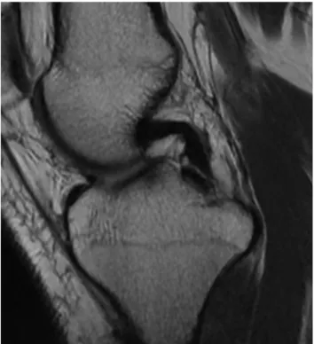 Figure 13. Anterior cruciate ligament: normal appearance. MRI: proton density frontal view with fat saturation