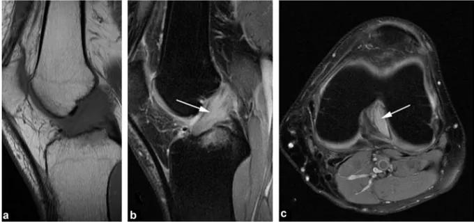 Figure 16. Complete rupture of the anterior cruciate ligament. MRI: T1-weighted sagittal views (a), PD fat-sat (b) and PD fat-sat axial view (c)
