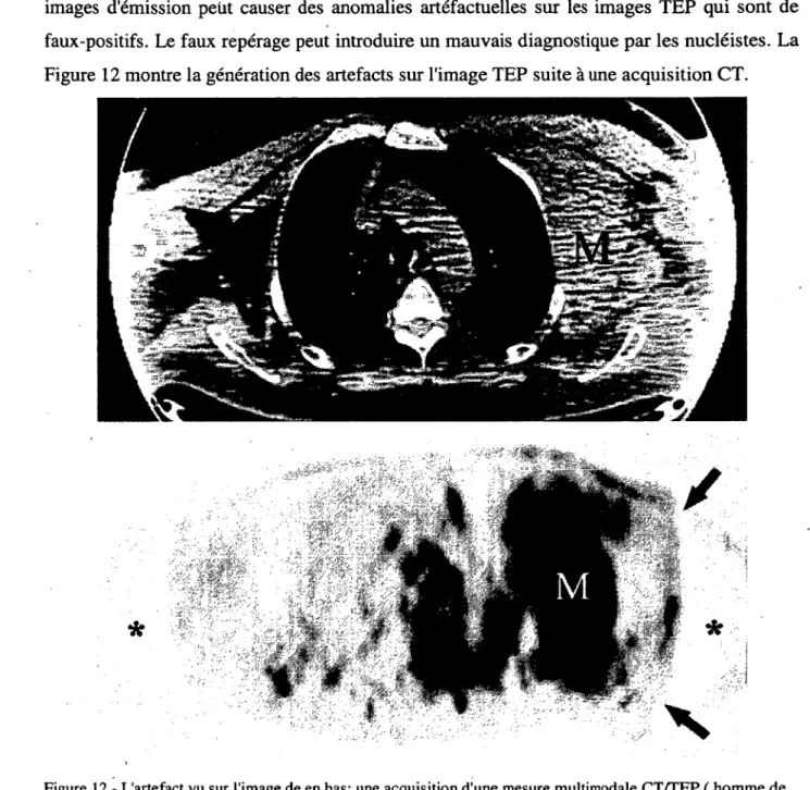 Figure  12  - L'artefact vu sur  l'image de en bas:  une acquisition d’u ne m esure multim odale C T /T E P  ( h om m e d e  48 ans), où le cham ps de vue pour le  CT est de 45-50 cm  et le cham ps de  vue pour la T E P  est d e  60-70 cm 