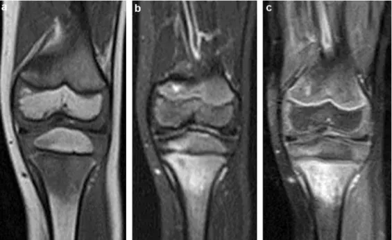 Fig. 1. Acute osteomyelitis of the proximal tibia with an area of intramedullary oedema in the metaphysis with T1 hypointensity (a), STIR hyperintensity (b) and increased gadolinium uptake (c).