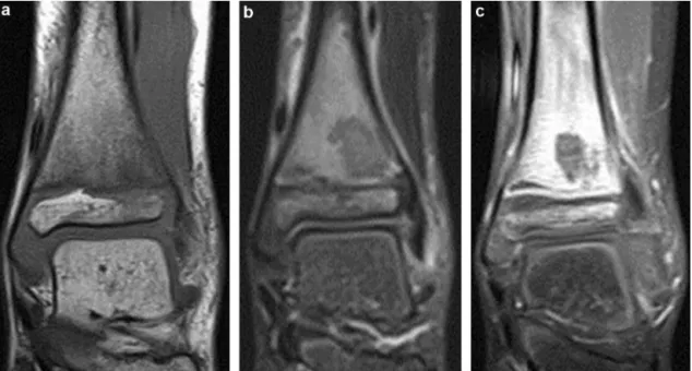 Fig. 4. Hypointense intra-osseous area on T1 (a), hypointense T2 Fat-Sat (b) without increased gadolinium uptake (c), suggestive of devascularized area in the distal tibia.