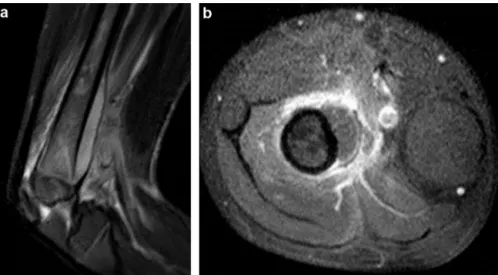 Fig. 5. Subperiosteal abscess of the distal femur with ﬂuid centre based on STIR hyperintensity (a) with increased uptake in the peripheral shell (b), with small soft tissue abscess in contact with the periosteal one.