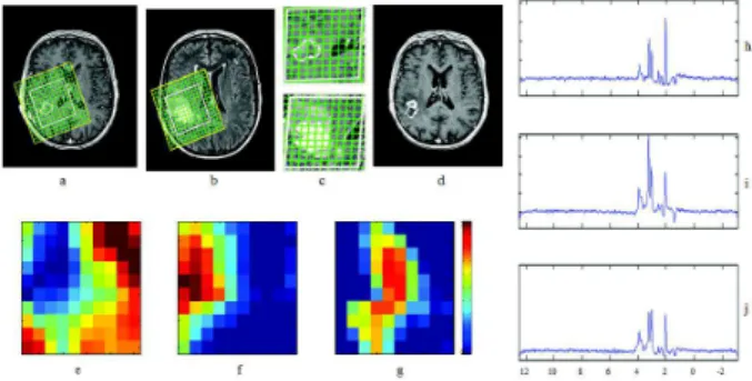 Fig. 3: T1-weighted after gadolinium injection and FLAIR images before treatment (a) and (b); corresponding voxels within the volume of interest (c); T1-weighted after gadolinium injection at relapse (d); Maps showing the spatial distribution of normal tis