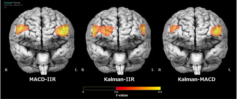 Figure 8. Comparison of the t-maps for the contrast High load - Low load on the level of HbO 2 over the prefrontal cortex obtained in function of the type of filter used for signal processing (classical IIR, MACD, or Kalman)