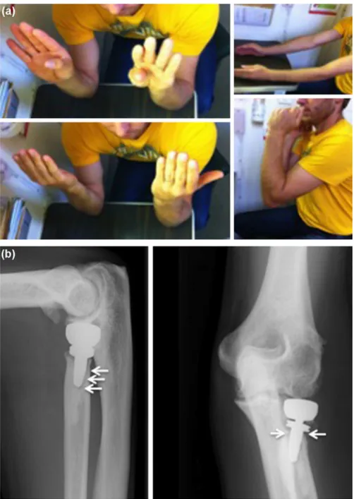 Fig. 17. a and b: young patient 4 years after treatment of a complex radial head fracture by implantation of a cemented bipolar prosthesis