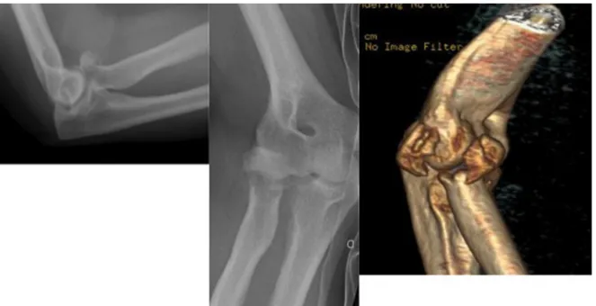 Fig. 6. Standard radiographs and 3D computed tomography reconstruction providing an evaluation of the extent of comminution