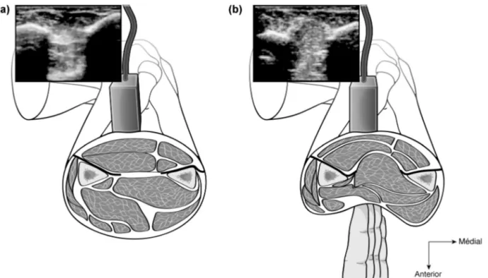 Fig. 8. “Muscular hernia sign” described by Soubeyrand et al. and indicating a tear in the inter-osseous membrane [15].