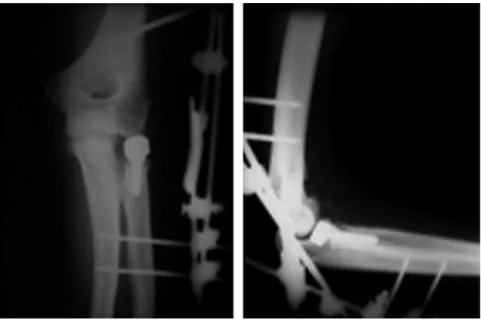 Fig. 15. External ﬁxation to stabilise the elbow in a patient with residual postero-lateral instability after treatment of terrible triad injury consisting of radial head replacement, re-attachment of the radial collateral ligament, ﬁxation of the coronoid