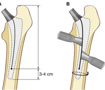 Fig. 11. A. Planning the femoral osteotomy, which spares the last 3–4 cm. B. Stem extraction after placement of a cerclage wire.