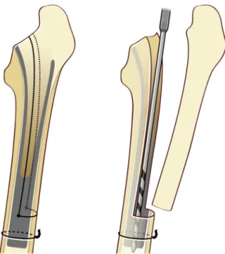 Fig. 14. The sarcophagus approach developed by Doré (series of windows) to pre- pre-serve the continuity of the lateral cortex.
