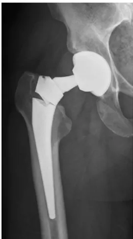 Fig. 1. Fracture of a femoral stem prolonged by a modular neck.