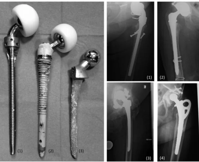 Fig. 5. Stems having the reputation of being non-removable: screw ﬁxation (1 and 2) or porous metal or similar coating (3 and 4).