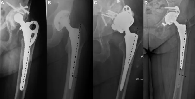 Fig. 6. Planning the length of the ﬂap. Stems with a porous metal coating (A), microporous coating (B), or partial coating (C)