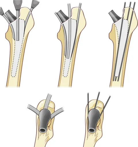 Fig. 10. Extraction of a cementless stem via the intramedullary canal. Slender chisels then pins are introduced to disrupt the bone connections.