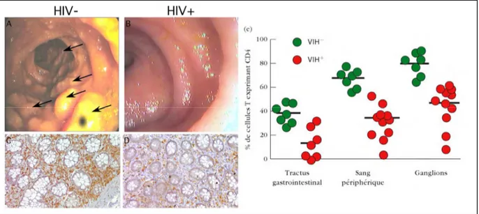 Figure 5 : Démonstration endoscopique et histologique de la déplétion en cellules  T CD4 +  du tube digestif de patients atteints de SIDA